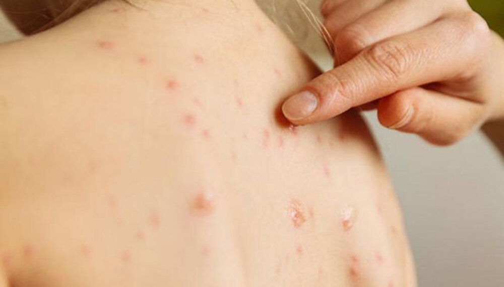 طغیان مسری‌ترین ویروس‌ جهان؛ افزایش ۴۰ درصدی مرگ و میر ناشی از این بیماری