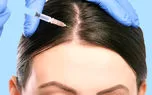 مزوتراپی مو چیست و چگونه برای درمان ریزش مو استفاده می شود؟