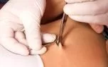 پیرسینگ ناف (Navel Piercing) چیست و چگونه انجام می‌شود؟